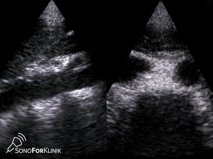 Aorta Abdominalis im Ultraschall